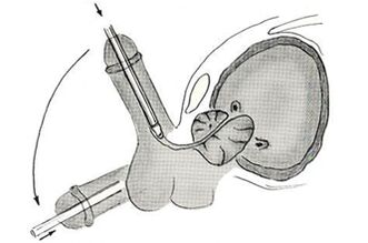 Scheme of endoscopic penis enlargement surgery. 