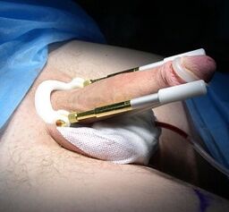 How an operation is performed to increase the penis