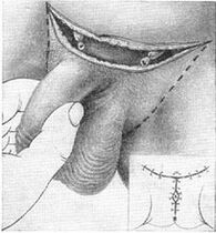 Surgical lengthening of the penis by removing its hidden part