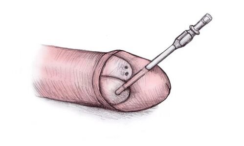 The head of the penis can be enlarged by injecting it with hyaluronic gel